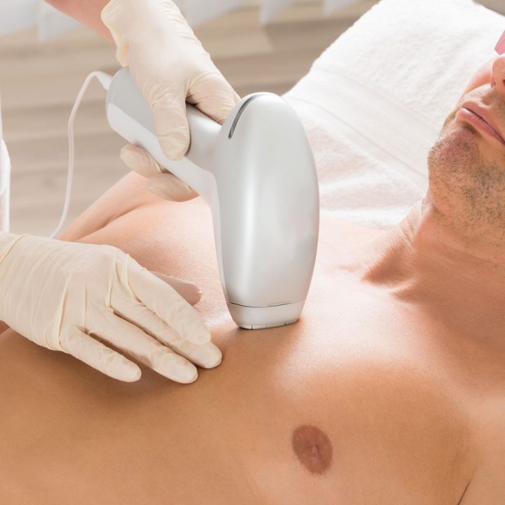 Laser Hair Removal Men's Upper Body Package of 8