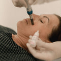 Microneedling treatments 1 Session