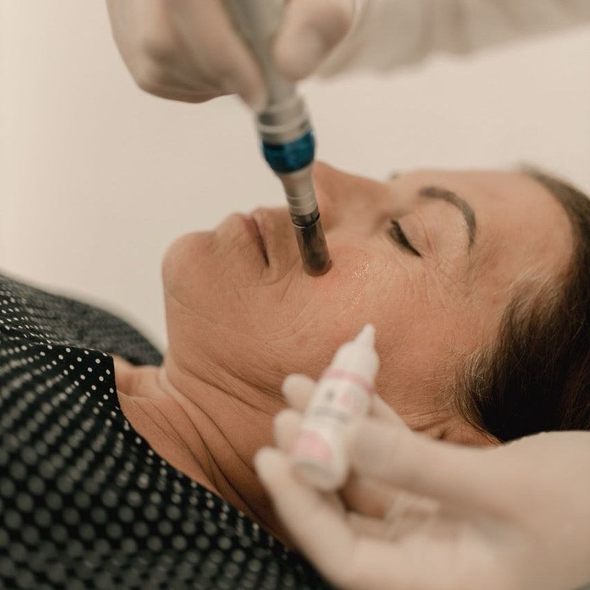 Microneedling treatments 8 Session